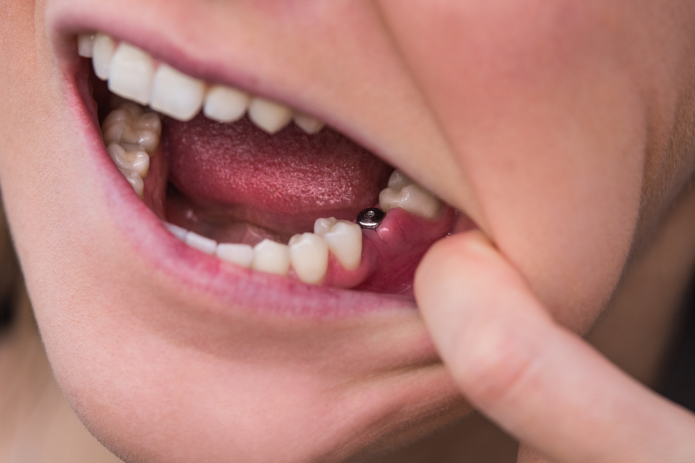 Single Tooth Implant Single Tooth Implant
